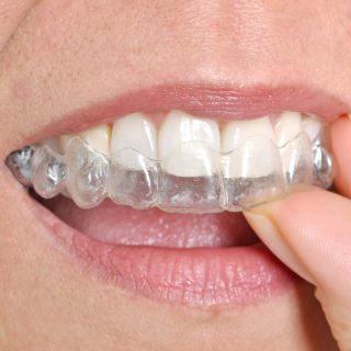 Invisalign offers a less visible way to straighten your teeth, but it requires you to adjust how you eat each day.